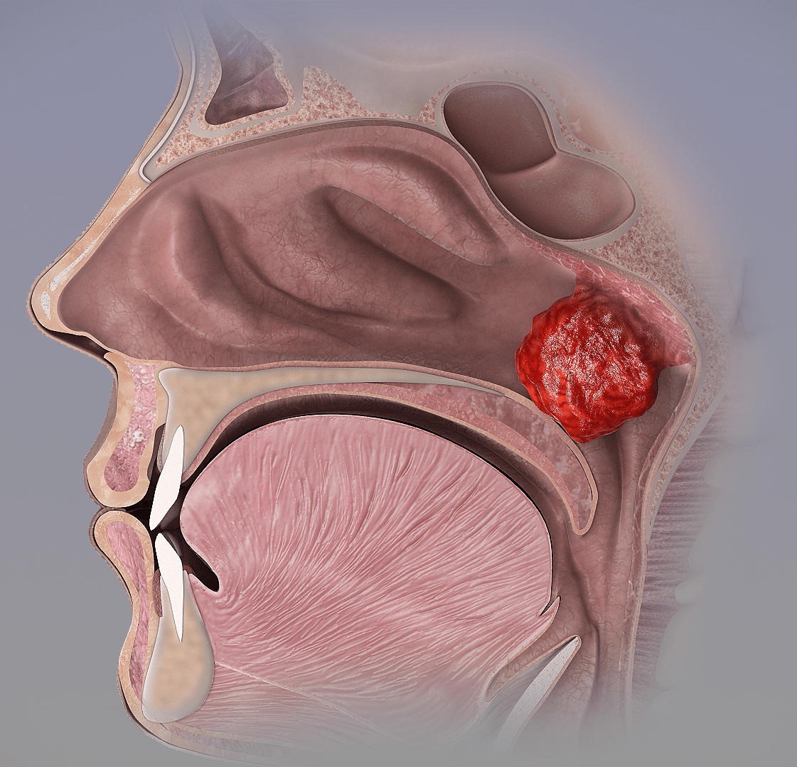 Adenoid-enlargement