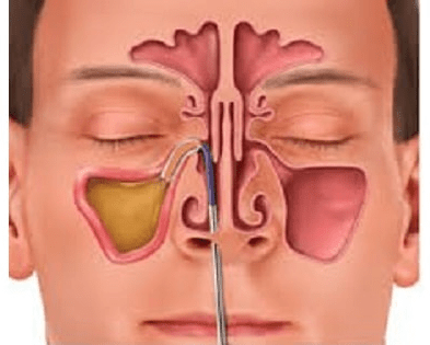 Balloon-sinoplasty