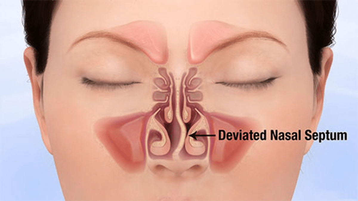 Deviated-nasal-septum