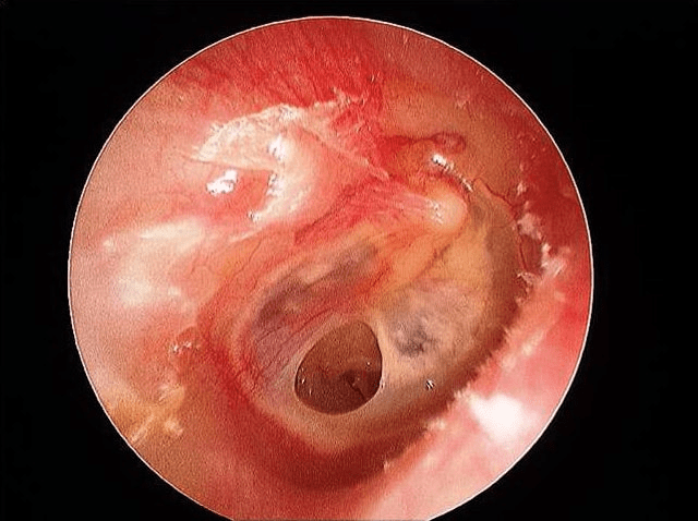Ear-drum-perforation-rupture