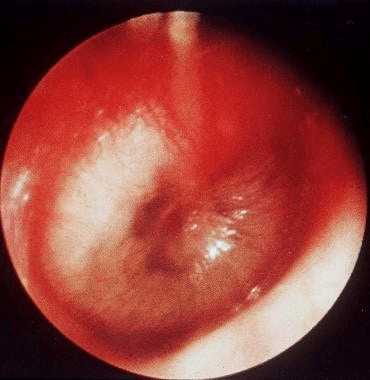 Ear-infection