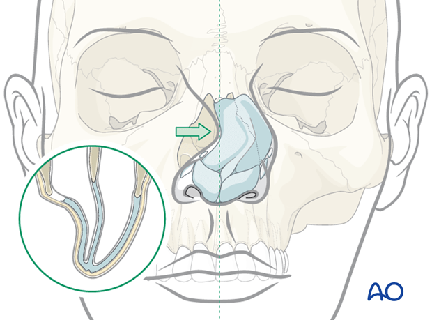 Fracture-nasal-bone