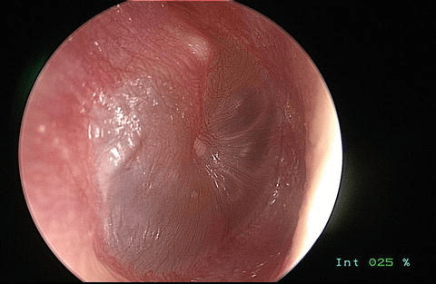 Middle-ear-infection