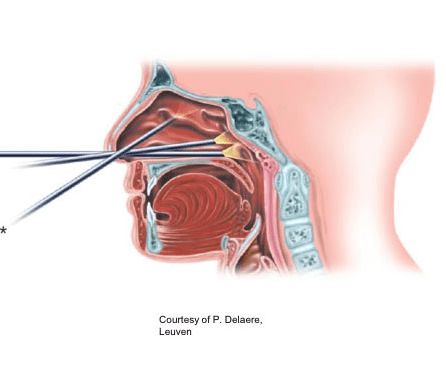 Nasal-endoscopy