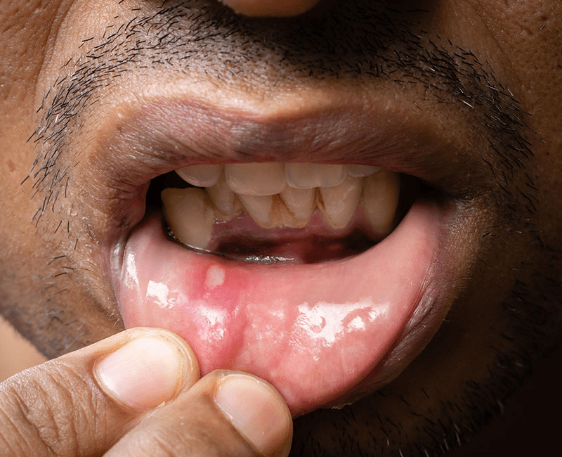 Oral-ulcers