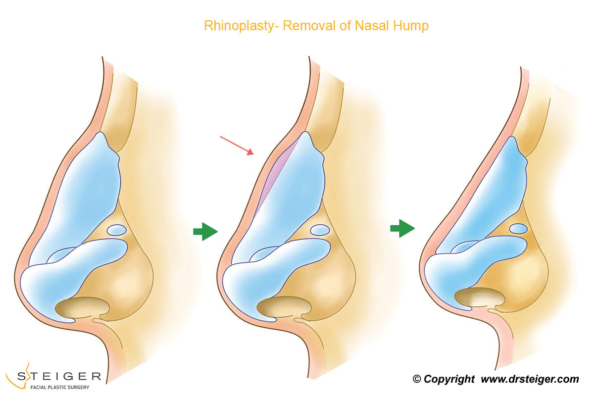 Rhinoplasty