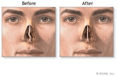 Septoplasty