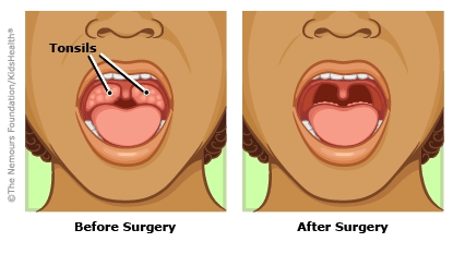 Tonsillectomy