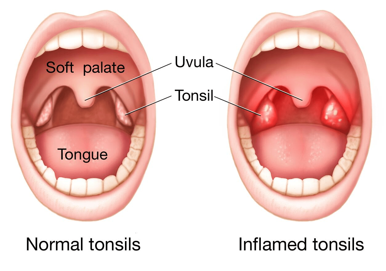 Tonsillitis