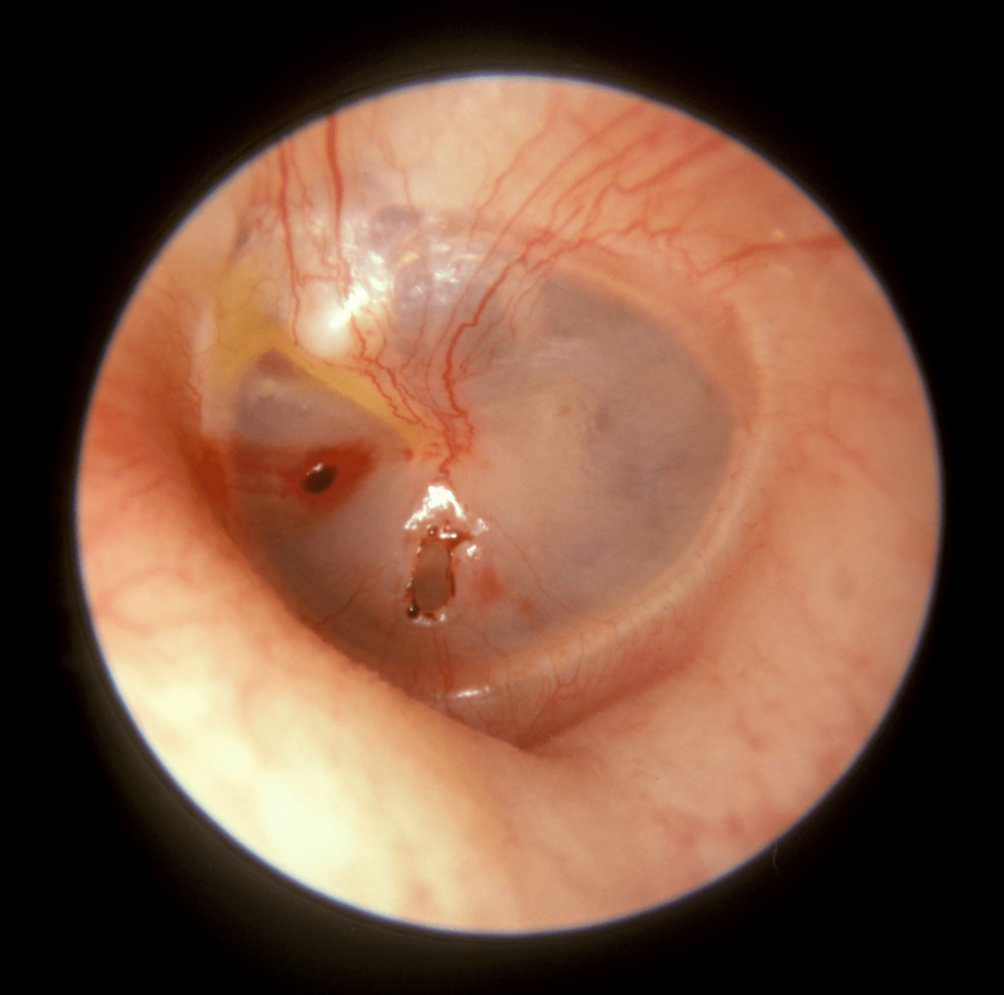 Traumatic-ear-perforation