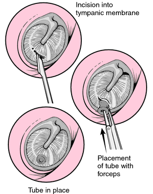 myringotomy