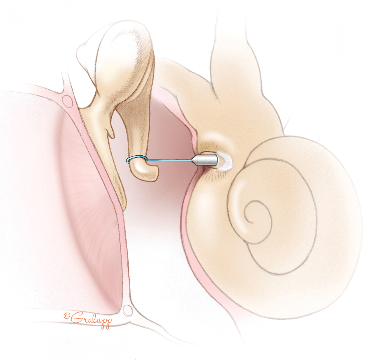 stapedotomy