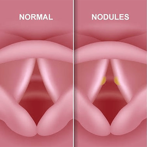 vocal-nodule