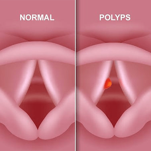 vocal-polyp